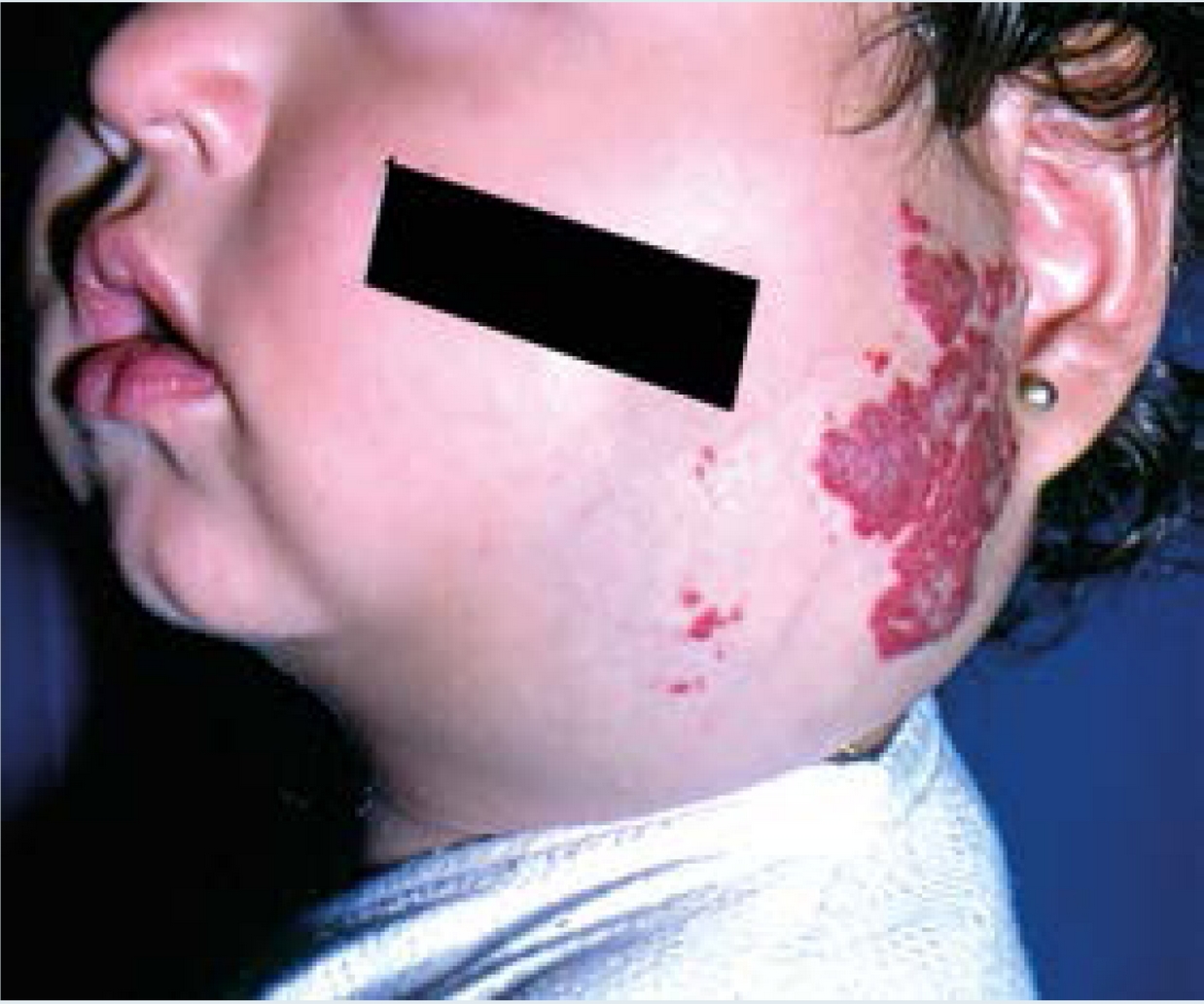 Hemangiomas Infantiles HernndezZepeda Acta Peditr