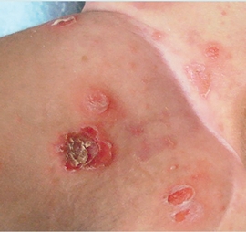 Impetigo Ampolloso Perez De La O Acta Pediatrica De Mexico